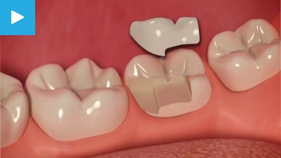 Worn & Chipped teeth