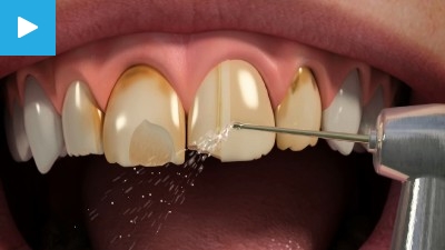 Worn & Chipped teeth
