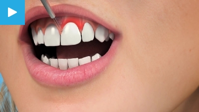 Tooth Lengthening