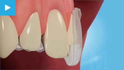 Tray whitening 