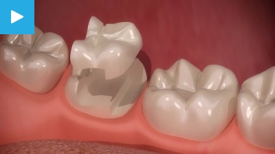 Worn & Chipped teeth