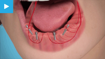 Implant retained dentures