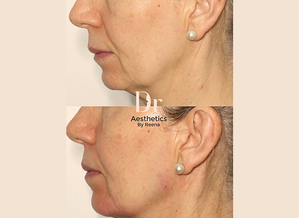 Dermal Filler