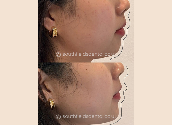 Dermal Fillers