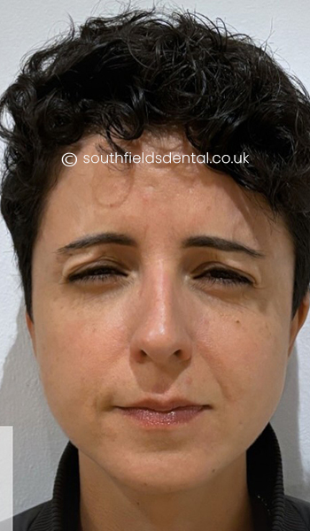 Anti-wrinkle-Injections-a1