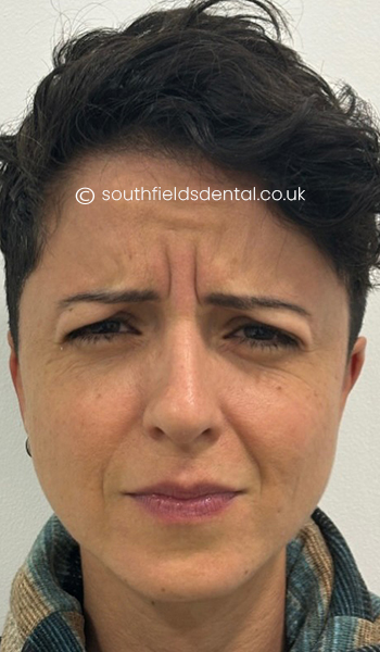 Anti-wrinkle-Injections-b