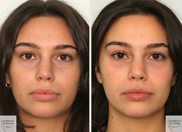 Dermal Filler