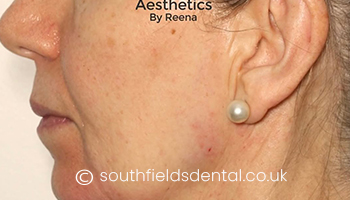 Jawline-Filler-a